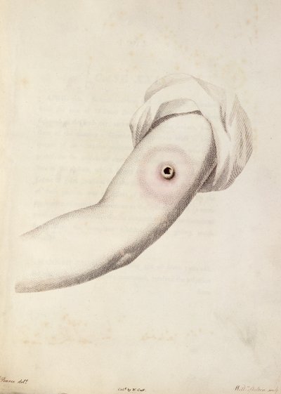 Cowpox Pustule on an Arm, from 